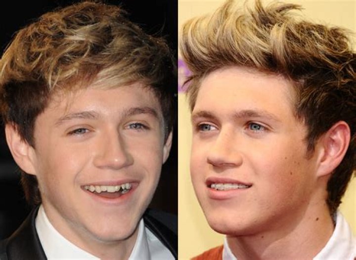 Did Niall Horan Have Braces?