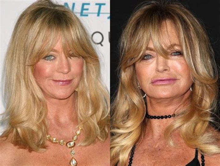 Has Goldie Hawn Had Plastic Surgery?